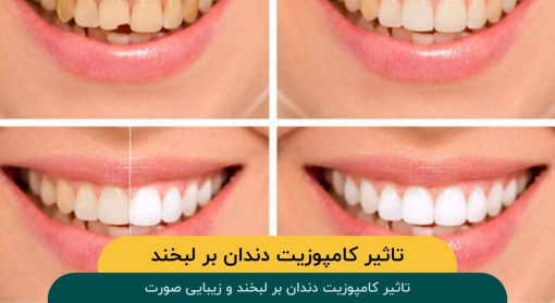 تاثیر-کامپوزیت-دندان-بر-لبخند